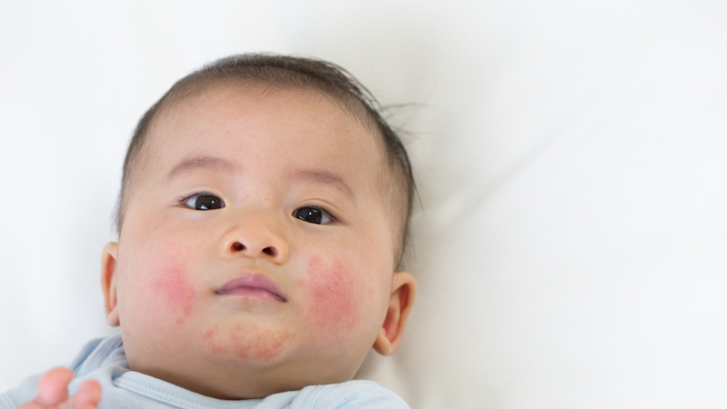 Baby Eczema