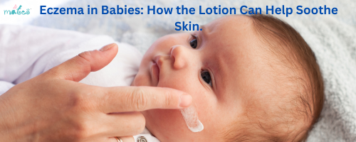 Eczema in Babies - Lotion to help soothe skin